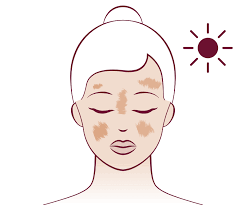 Homeopathic solutions for Acne Skin Care